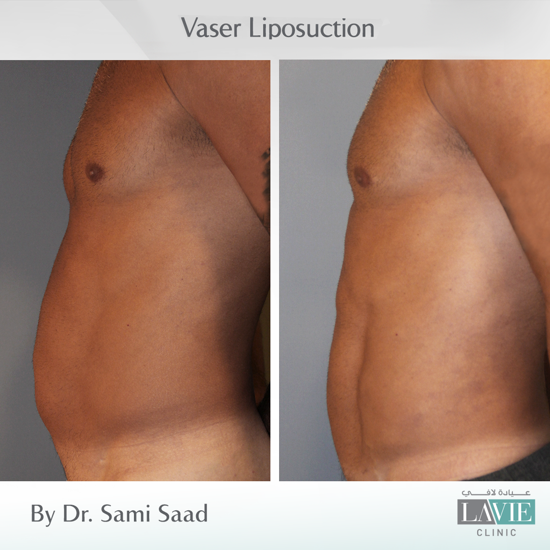 sami-saad-vaser-liposuction