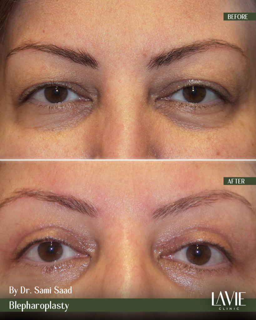 Dr-Sami-Blepharoplasty1