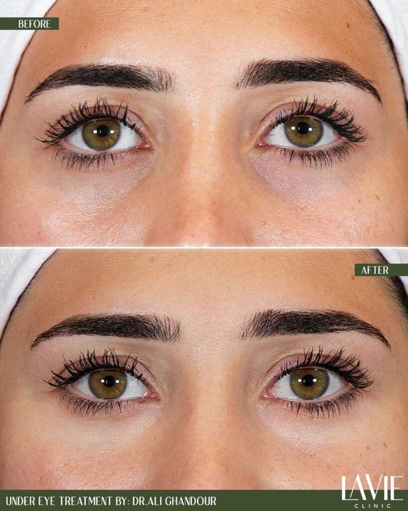 Under-eye treatment with Dr. Ali Ghandour