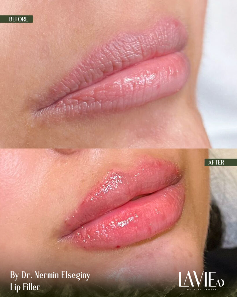Lip-Filers by Nermin