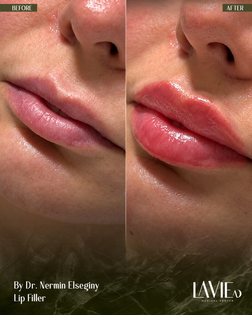 lip fillers by Nermin